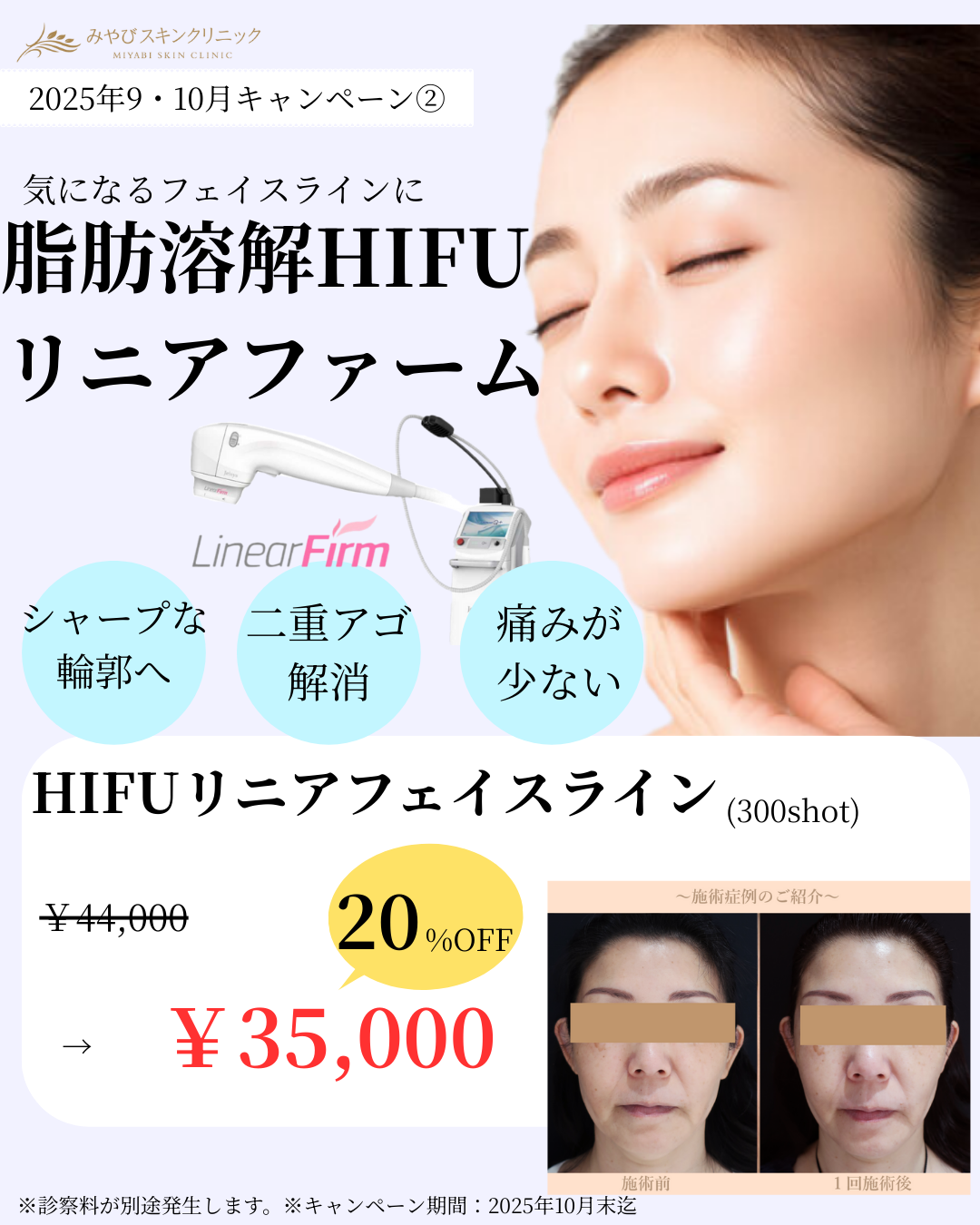 9・10月限定のお得なキャンペーン【ヒアルロン酸注入】と【脂肪溶解リニアHIFU】