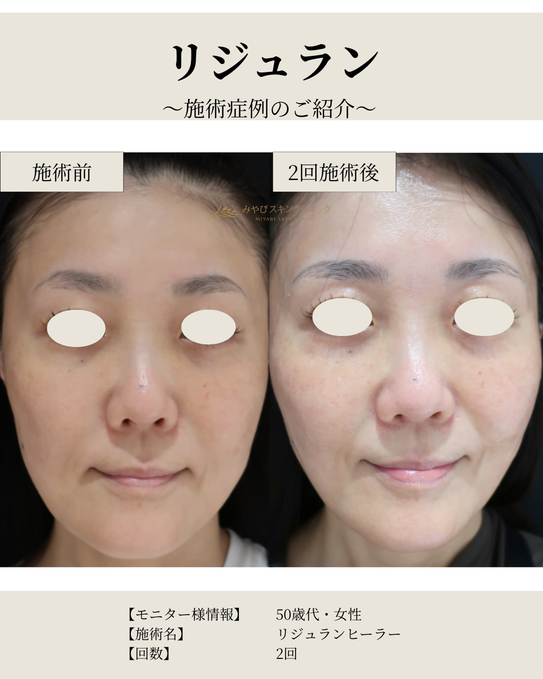 リジュラン　【モニター募集】